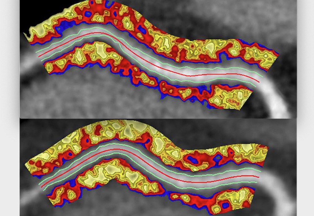 A comparison CT scan of a coronary artery with inflammation in before and after one year of taking psoriasis biologic drug therapy. The top image shows areas of red inflammation and the bottom shows a year later with reduced inflammation. This NIH study may pave the way for new ways to risk assess patients using CT and to treat them using existing drug therapies. Image from the Oxford Academic Cardiovascular CT Core Lab and Lab of Inflammation and Cardiometabolic Diseases at NHLBI.