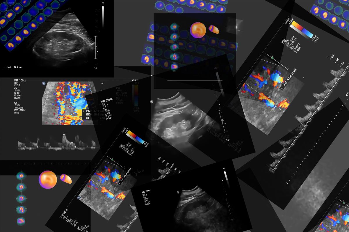 ​ Coronary computed tomography angiography (CCTA) is cheaper, easier to use and its results are easier to understand than Intravascular ultrasound (IVUS), making it ideal for clinical trials of cardiovascular (and other) drug candidates. Additionally, advances in computing and artificial intelligence (AI) are enabling precise measurement of changes in atherosclerosis disease progression, including the ability to identify, classify and quantify plaque tissue structure and composition. Importantly, plaque progression has been established as a surrogate endpoint for increased cardiovascular (CV) events and risk, another reason CCTA is excellent for evaluating CV therapeutics in clinical trial settings.    Coronary computed tomography angiography (CCTA) of the heart and coronary vessels using contrast fluid and stress to determine whether they have been narrowed.  IVUS and CCTA: Substance Over Surface IVUS uses a catheter with a distal miniaturized ultrasound transducer that is threaded through the vasculature into the coronary vessels. The sound waves reflected from the interior vessel walls are processed to produce images of the endothelial lumen. IVUS images can provide information about the amount and type of plaque buildup, one measure of risk for heart attack.  However, as an invasive procedure, IVUS does pose some risk to the patient, including the potential for complications including dissection, perforation, arrhythmia, thrombosis and vasospasm. IVUS scans are more expensive and time-consuming than CCTA scans, and, crucially, although they generate images of the surface of the interior vessel wall, they don’t assess the extent or composition of plaque deposits.  Like IVUS, CCTA is used to evaluate plaque buildup in the coronary arteries; unlike IVUS, it is non-invasive, removing the risks of IVUS detailed above. Instead, the patient is injected with a contrast agent containing iodine; high-speed CT scans provide detailed images of a variety of tissue types, including coronary plaque. CCTA requires less space