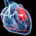 ESC Abbott Updated Guidelines