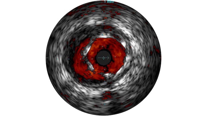 Example of Philips' IVUS ChromaFlo imaging to show blood flow inside the vessel.
