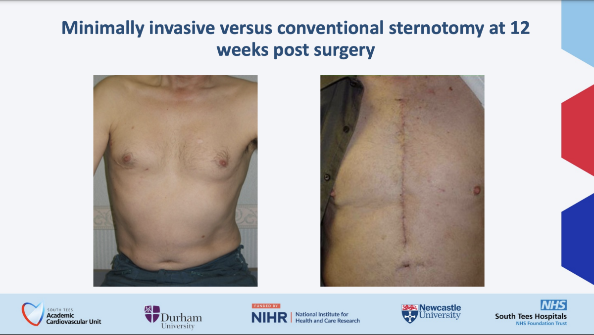 Minimally invasive vs conventional sternotomy