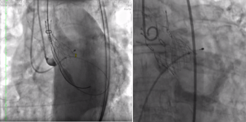 TAVR