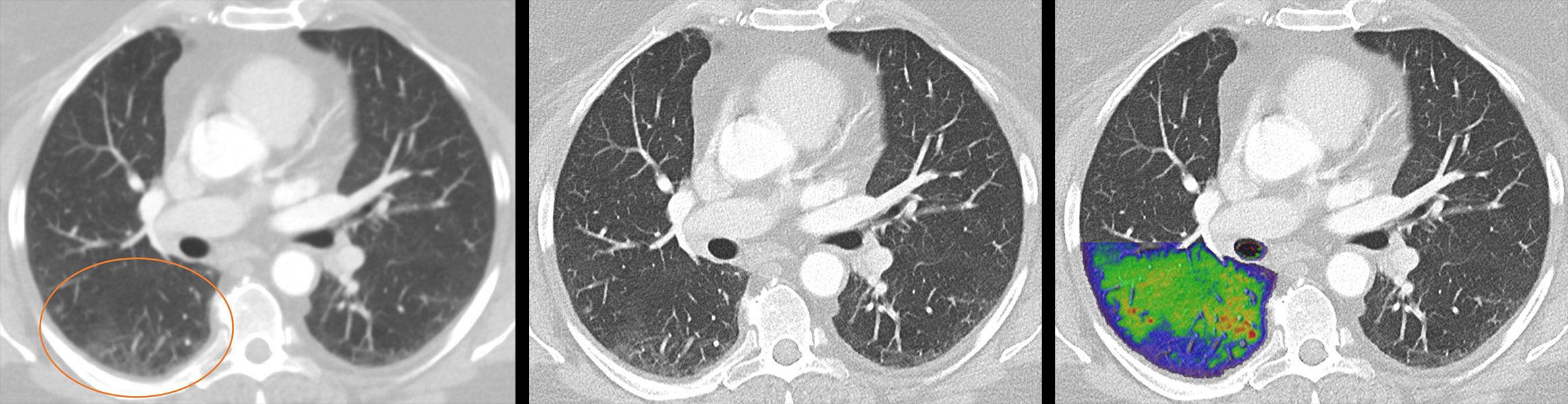 Lung images of a post-COVID patient with photon-counting CT. The photon-counting technology allows simultaneous acquisition and visualization of detailed structures (center image) combined with functional information (right image). For comparison is an image with conventional CT (left). Courtesy of Dr. J. Ferda, University Hospital Plzen, Czech Republic.