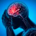 Stroke Cancer Link