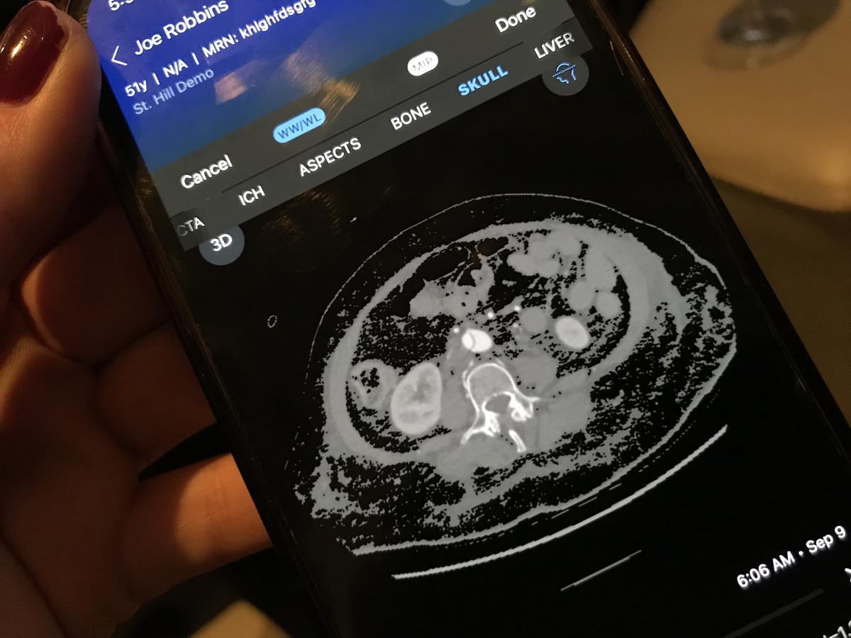 Example of the Viz.AI aortic dissection AI detection alert system app.