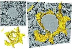 Sections through the three-dimensional reconstruction volume (upper left, grey) around a pulmonary alveolus with hyaline membrane (lower left, yellow). On the right, the images are superimposed. In the centre is the air bubble (alveolus). The electron density is represented by different shades of grey. On the inside of the air bubble is a layer of proteins and dead cell residues, the "hyaline membrane". #COVID19 #SARScov2