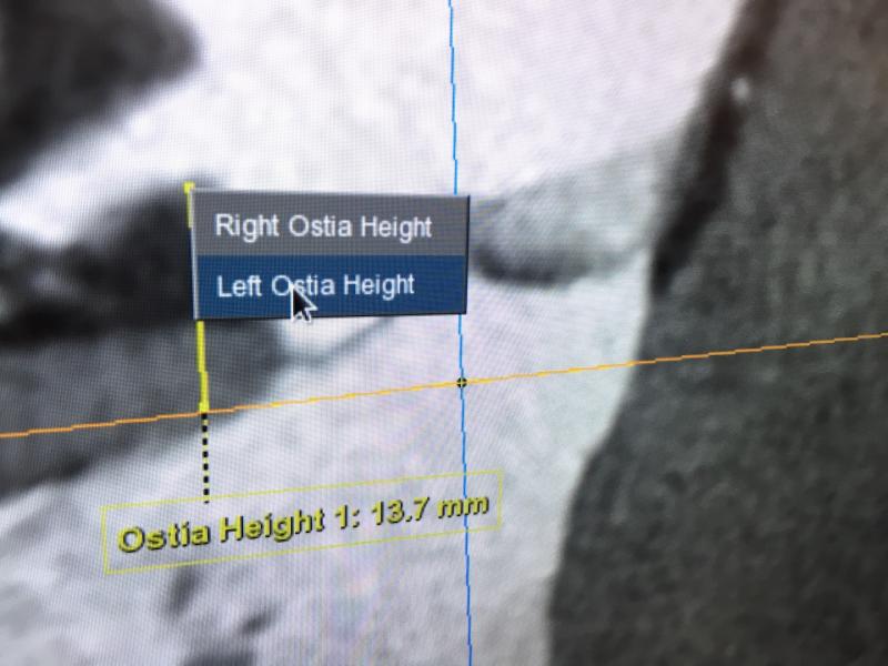 An example of GE Healthcare's TAVR software automation, showing a quick measurement line and the system automatically showing the distance.