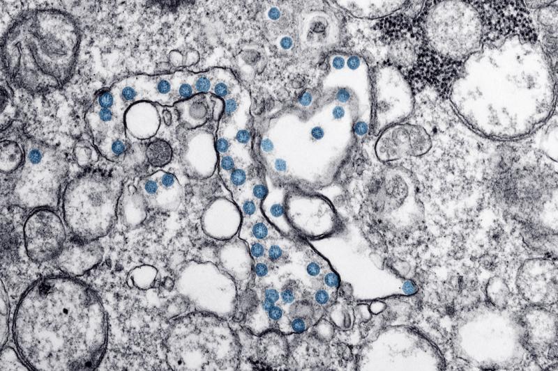 Novel coronavirus (COVID-19, SARS-CoV-2) virus as seen under a microscope in an image released by the Centers for Disease Control and Prevention (CDC). #COVID19 #SARScov22