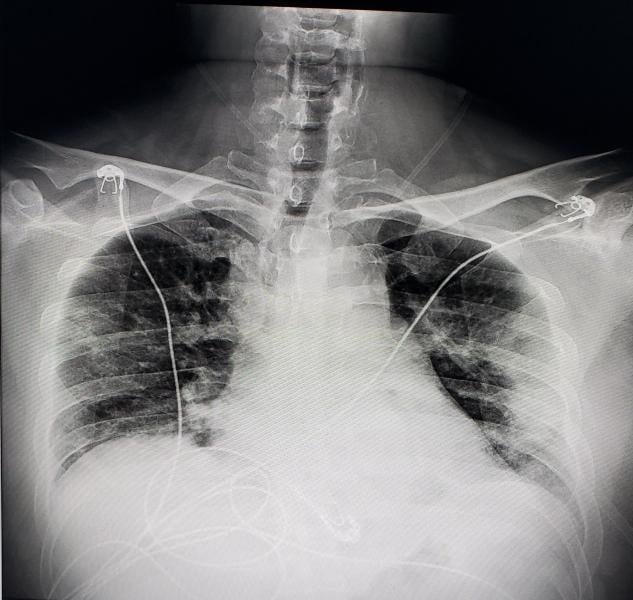 A chest X-ray of a U.S. COVID-19 positive patient showing pneumonia, which appear as hazy, smoky ground glass lesions along the lower chest walls. Photo from radiologist John Kim, M.D.