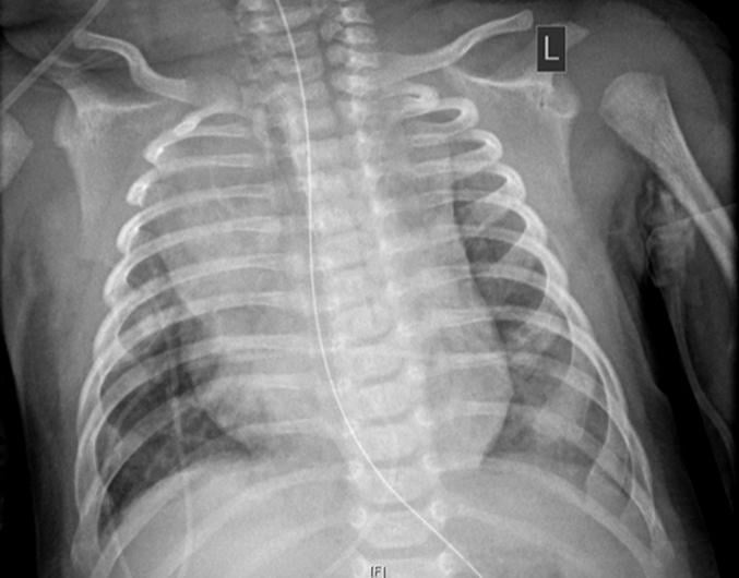 Chest X-ray of a  2-month-old infant diagnosed with COVID-19 showing an enlarged heart, bibasilar opacities caused by collapse of the lower sections of lungs, and right upper lobe atelectasis (lung collapse). Find more information and figures on this patient case.