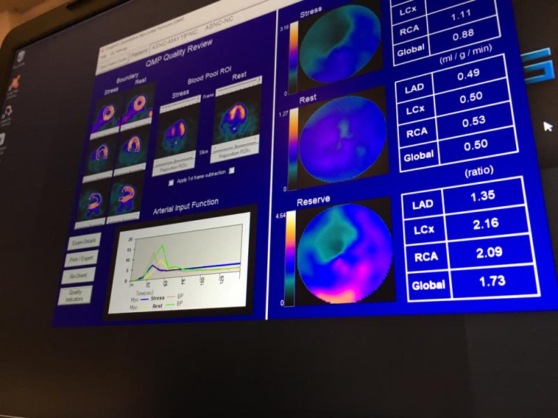 One of the newer technologies discussed in sessions at ASNC 2019 is the use of quantitative myocardial perfusion (QMP) flow reserve to enhance PET imaging. This is an example of software to perform this from the vendor Cardiovascular Imaging Technologies on the expo floor. Flow reserve can help show the severity of the ischemia detected on a PET scan and help show its cause and course of therapy. It takes the stress QMP divided by the rest scan QMP to offer a ratio for the flow reserve. #ASNC
