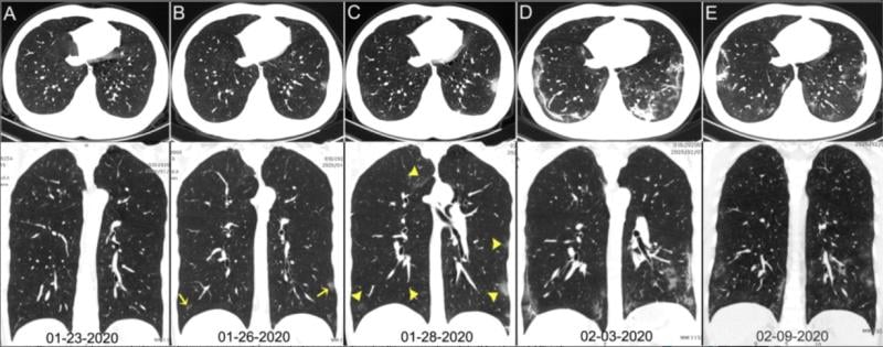 COVID pneumonia in the lungs from CT scans from China. Image courtesy of Radiology