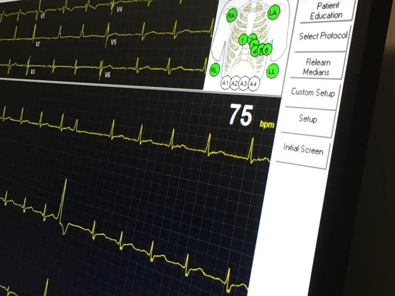 An example of a patient ECG during a cardiac perfusion exam on Rush's dedicated PET-CT system.