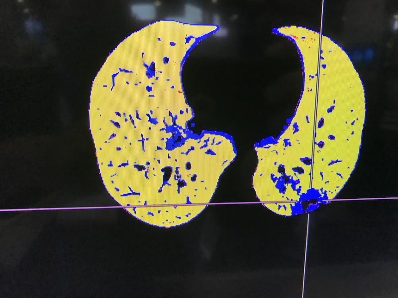 COVID-19 pneumonia in blue and normal lung tissue in yellow seen in a CT reconstruction software developed by Fujifilm on its Synapse 7X enterprise imaging system at the Healthcare Information Management Systems Society (HIMSS) 2021 meeting. The software separates are areas of diseased tissue based on the density determined from the CT Hounsfield units. #COVID19