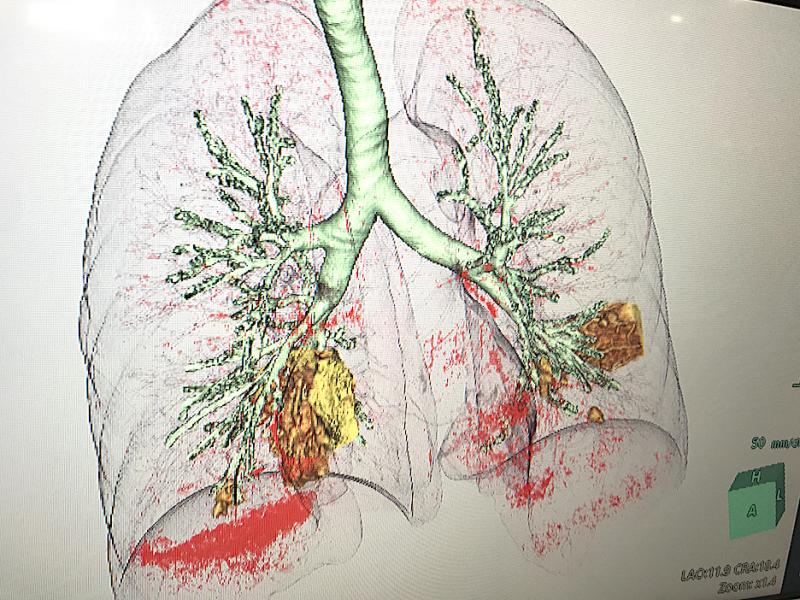 COVID-19 pneumonia in yellow seen in a CT reconstruction software developed by Fujifilm on its Synapse 7X enterprise imaging system at HIMSS. #COVID19 #HIMSS21