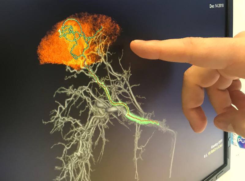GE's Liver Assist embolization guidance technology at RSNA 2021. They showed an enhancement where a virtual map can be created to show how an embolization will effect the tissue downstream to better plan catheter embolization procedures in the cath lab.