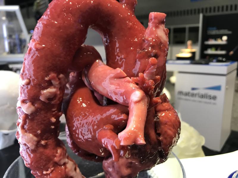 Example of life-like 3D printed cardiac and aortic anatomy available from Materialise. The vendor's software is FDA-cleared for use to print anatomy from CT or MRI studies that will be the exact size as the patient's actual anatomy. This can be used for planning and practicing complex surgical or interventional procedures and the model can aid navigation during procedures. 