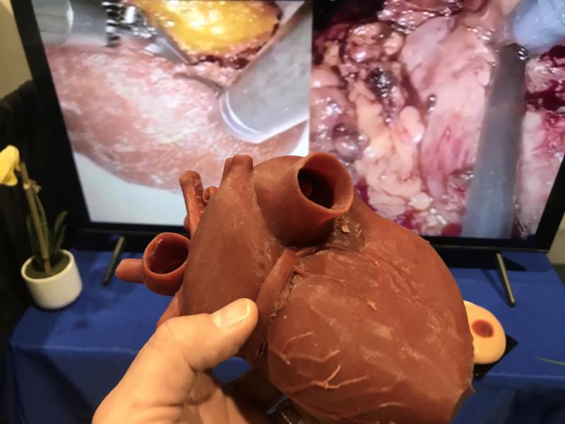 Example of flexible 3D printed heart that can be made to the exact size of a patient from their CT scan from Materialise. It can be used to practice procedures and check device sizing. 
