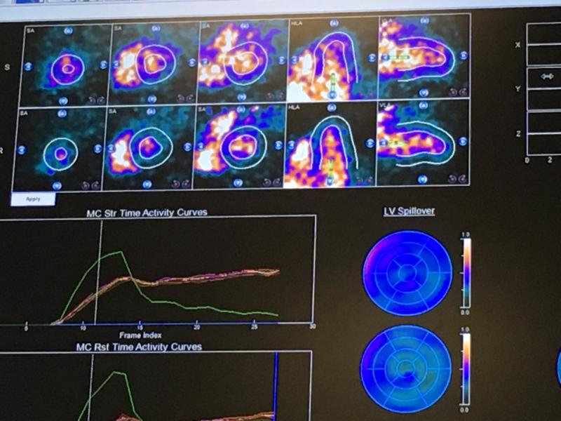 An example of a cardiac perfusion exam from Rush's dedicated PET-CT system.