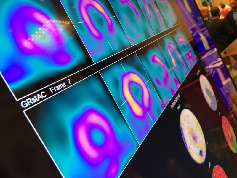 This is 4MD’s cardiac nuclear imaging analysis software, shown here integrated with a ScImage cardiovascular information system (CVIS). Both companies displayed on the expo floor at ASNC 2019. The software creates a single page report seen here. #ASNC #ASNC19 #nuclearimaging