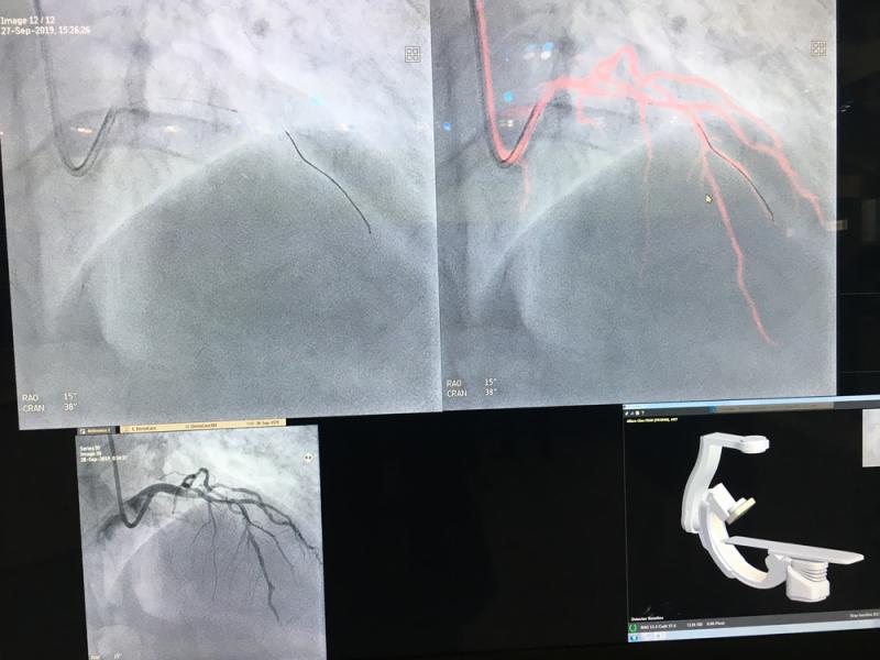 #TCT2019 #TCT #TCT19 An example of Philips' vascular roadmapping technology, which fuses a CT or a rotational angiography 3-D coronbary tree model to live fluoro to help guide wires and devices without the need to use more contrast.