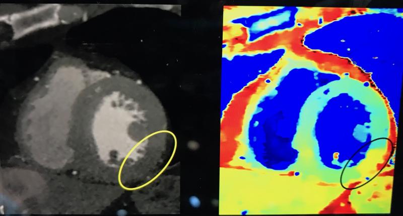 Example from Philips spectral CT system showing the conventional cardiac CT and a spectral image that can better enhance iodine contrast to reveal an area of ischemia or infarct in the myocardium.