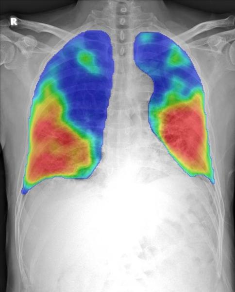 COVID-19 pneumonia color coded in red and yellow by an automated artificial intelligence (AI) analyses tool to prescreen chest X-ray images from the new Thirona and Delft Imaging CAD4COVID detection software. It is intended to support healthcare manage COVID-19 cases. The tool will help triage COVID-19 cases and indicate the affected lung tissue. The software is being made available free-of-charge in support of the crisis.