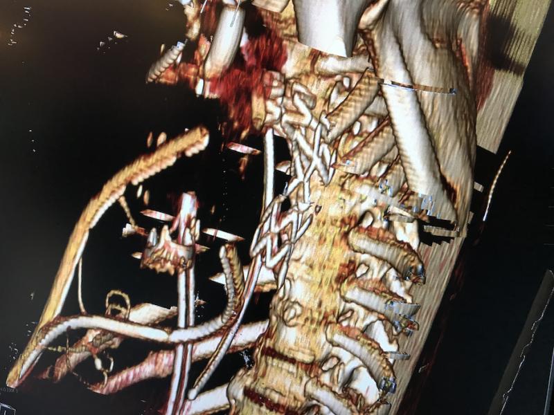 A CT 3D reconstruction image of a cardiology frequent flyer patient with numerous implants, including a prosthetic heart valve and a thoracic aortic aneurism stent graft. The image was shown on the new Visage Imaging Cloud PACS platform to show how multi-modality imaging can be stored and retrieved in the cloud very quickly without requiring access to multiple systems or software. Many radiology PACS and cardiovascular information systems (CVIS) are moving to new cloud-based platforms. #HIMSS #HIMSS21