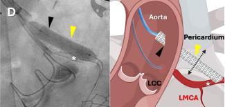 Researchers Perform First Minimally Invasive Coronary Artery Bypass