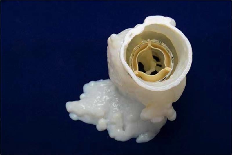 A 3-D printed aortic root with an simulated implant of an Edwards Sapien TAVR valve. New clinical data points to length-of-stay as a new predictor of outcomes in TAVR patients. Image from Henry Ford Hospital. 