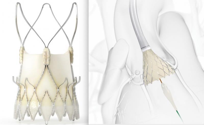 The Boston Scientific Acurate neo self-expanding TAVR valve (left) did not perform as well clinically as the Medtronic CoreValve Evolut TAVR valve (right) in the SCOPE II trial presented at TCT 2020. #TCT #TCT2020 #TCTconnect