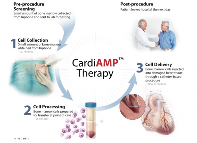 The BioCardia cardiac stem cell CardiAMP trial is a Phase III study looking at the efficacy of using stem cells to improve heart function in heart failure patients. It is the first trial for this technology to reach Phase III trial.