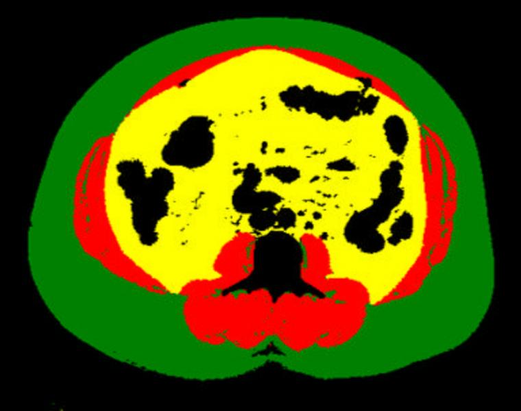 An example of a body composition analysis of an abdominal CT slice with the subcutaneous fat in green, skeletal muscle red and visceral fat in yellow. This was automatically identified and analyzed via a deep learning algorithm to assess the risk for heart attack and stroke in more than 12,000 patients. #RSNA2020 #RSNA20 #RSNA