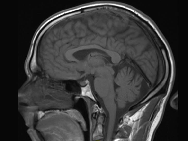 gadolinium, brain, contrast MRI, Radiology, Kanal