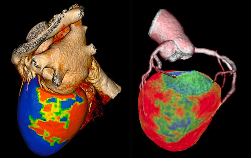 Two examples of CT myocardial perfusion (CTP) imaging assessment software. Canon is on the left and GE Healthcare is on the right. Both of these technologies have been around for a few years, but there have been an increasing amount of clinical data from studies showing the accuracy of the technology compared to nuclear imaging, the current stand of care for myocardial perfusion imaging, and cardiac MRI.