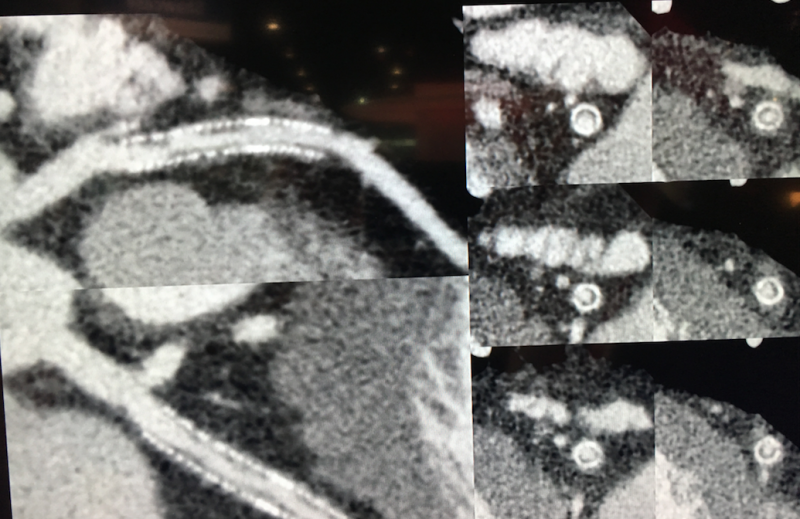 The use of metal artifact reduction software on this CCTA (CTA) cardiac CT from an Canon, Toshiba, Aquilion Precision, allows clear visualization inside a coronary stent. The 0.25 mm high-resolution reconstruction also helps delineate the various components of plaque.