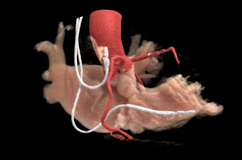 A cardiac CT of a patient with pacemaker leads, which can be challenging to get good images due to metal artifact. This image was rendered from using Canon's AiCE AI-assisted interactive reconstruction with Global Illumination 3-D rendering from a scan on an Aquilion One Genesis SP system.