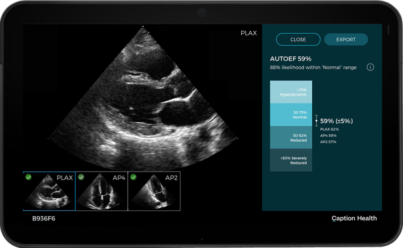 Acquisition aligns with strategy to deliver precision care and expands access to new ultrasound users and clinical uses