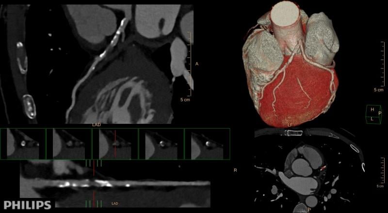 CT angiography, CTA, coronary CT, cardiac CT, SCCT, society of cardiovascular computed tomography, cardiac imaging