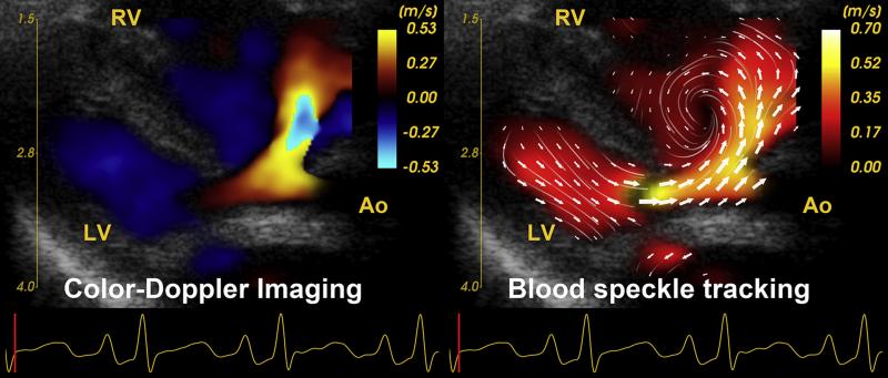 A comparison of color-flow Doppler cardiac ultrasound showing blood flow, and blood speckle tracking revealing a more detailed and complex understanding of the low. It shows the formation of a vortex that may play a role in future assessments for the efficiency of flow in the heart and vessels. #ASE21 #ASE2021 #Vectorflowimaging