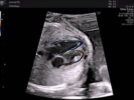 Cardiac Ultrasound Software Streamlines Fetal Heart Exams
