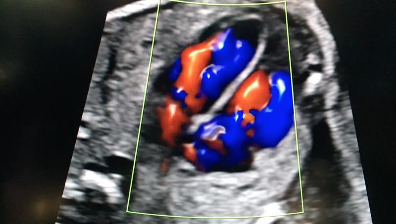 This is 3-D blood flow view of blood flow through the chambers of a fetal heart using the GE Healthcare fetalHQ analysis software. #RSNA18 #RSNA #RSNA2018