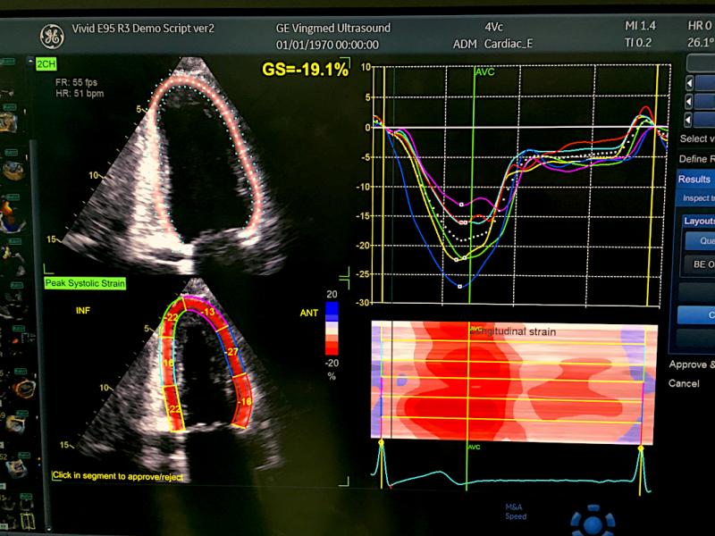An example of artificial intelligence on the GE Healthcare Vivid E95 system shown at ASE 2019 where the AI automatically pulls in an exam, identifies the left ventricle and myocardial boards and then calculates all the strain measurements in less than 10 seconds. While AI automation can greatly speed workflow, there are questions about the accuracy of AI for the next step in making diagnoses.  #ASE #ASE21 #ASE2021 #AI