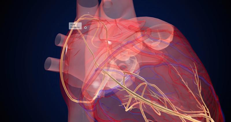 North America to account for larger share in atrial fibrillation market during 2022–2028; growth driven by rising geriatric population, increasing occurrence of cardiovascular diseases, high accessibility to advanced technologies, growing development of innovative and technologically advanced products, and increasing healthcare expenditure