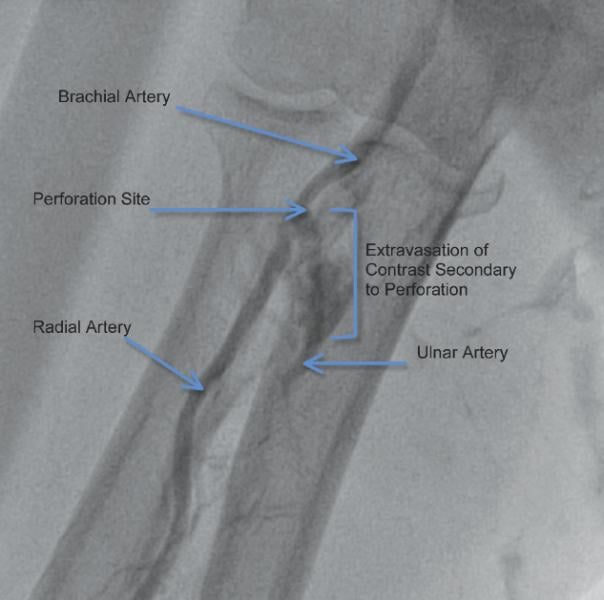 A radial artery angiogram demonstrating perforation of the radial artery at the bifurcation with the brachial artery, with evidence of extravasation of contra