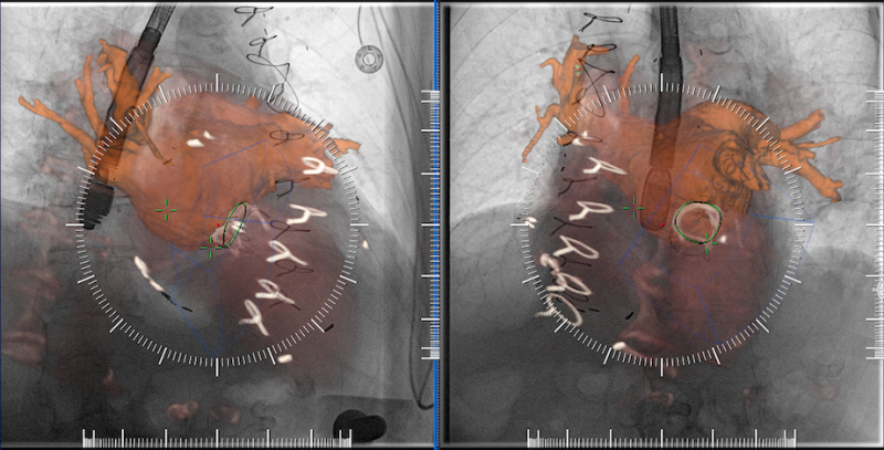 An example of multimodality image fusion with live angiography to enhance soft-tissue visualization during complex procedures. This example is from Siemen's new TrueFusion software released in 2018. Advances in angiography imaging.