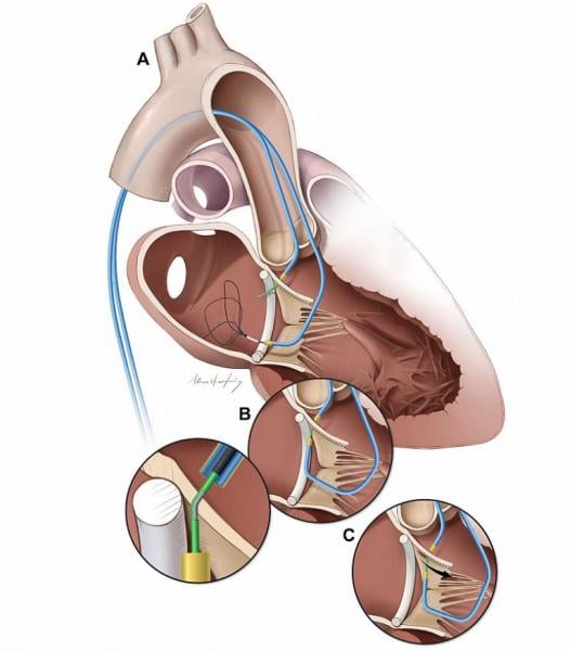 Illustration showing the catheter steps for the LAMPOON procedure designed to prevent left ventricular outflow tract (LVOT) obstruction . From Dr. Jaffar M. Khan and the Laboratory of Cardiovascular Intervention, led by Dr. Robert J. Lederman.