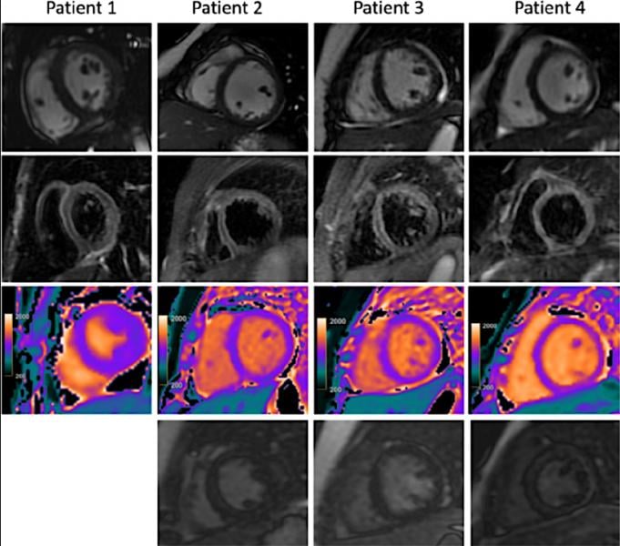 Cardiac MRI for four children with clinical diagnosis of acute myocarditis in the setting of COVID-19–related Kawasaki-like symptoms of Multisystem Inflammatory Syndrome in Children (MIS-C). Cardiac MRI of COVID pediatric COVID-19 patients.