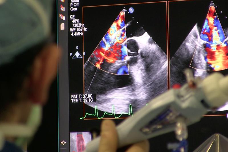 Transesophageal echo (TEE) being used to guide the deployment of a MitraClip device during a structural heart procedure at the University of Colorado Hospital. The center has performed more than 200 MitraClip mitral valve repairs over the past decade. Photo by Dave Fornell