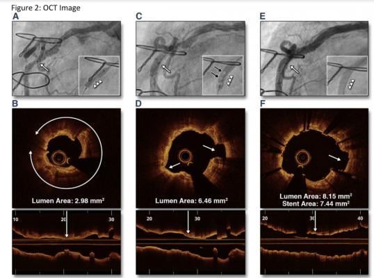 A comparison showing angiography and optical coherence tomography (OCT) views of an undilated mid right coronary artery calcified lesion, post dilation with the Shockwave intravascular lithotripsy system, and the final result after stenting. The technology allows calcified lesions to be broken up without the need for vessel trauma caused by high pressure balloons or atherectomy. 